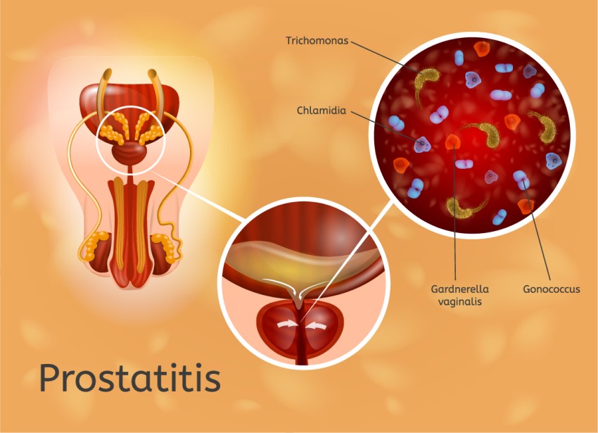 Bildliche Darstellung Prostatitis