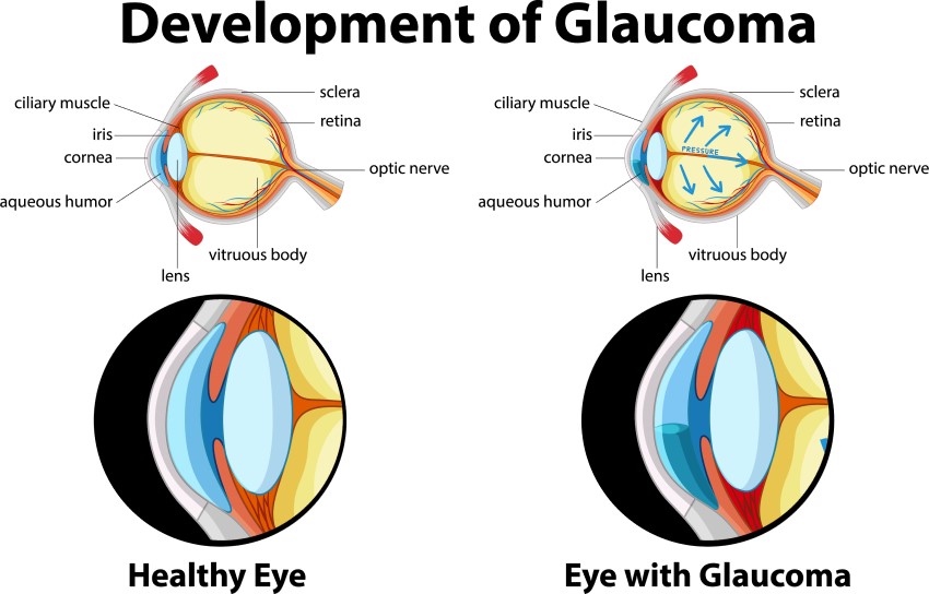 Darstellung der Entwicklung eines Glaukoms