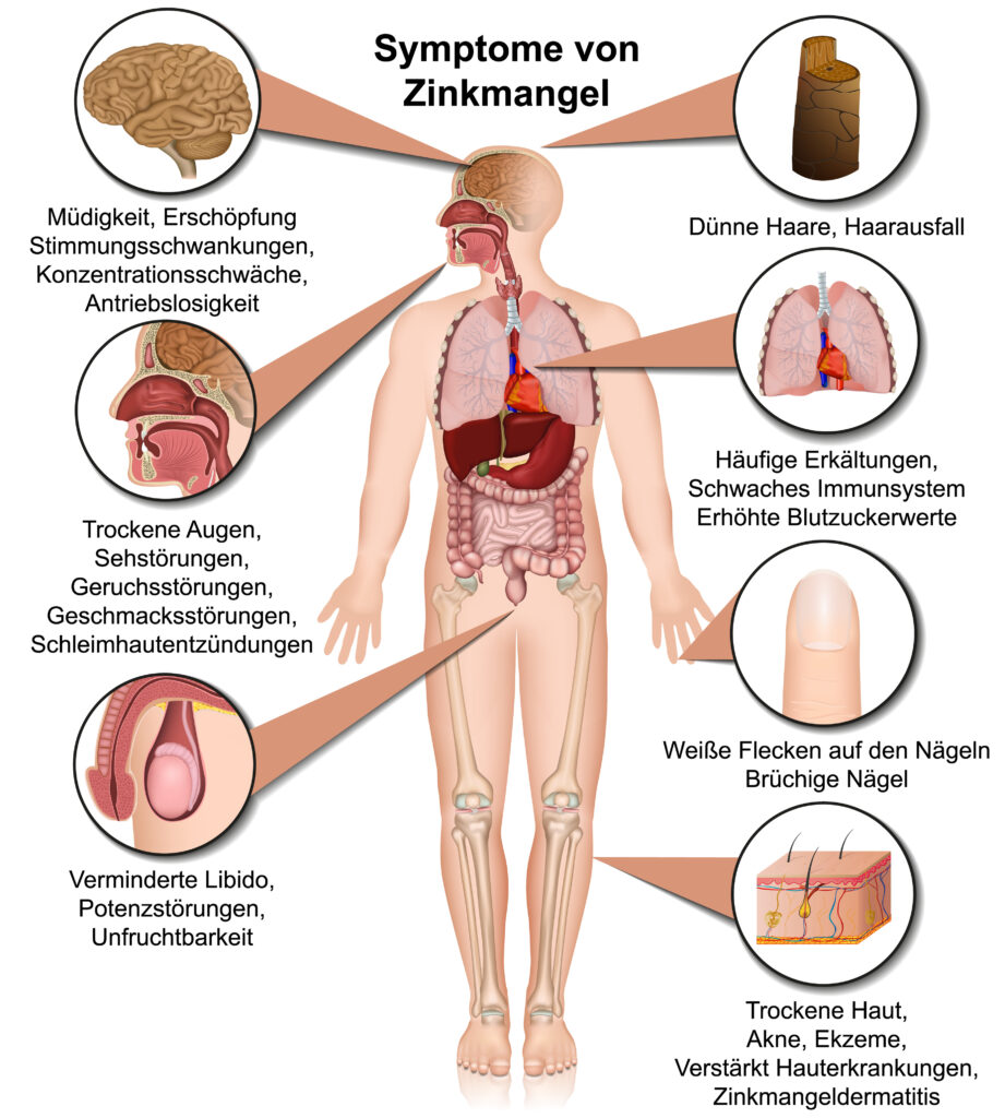 Darstellung der Symptome eines Zinkmangels