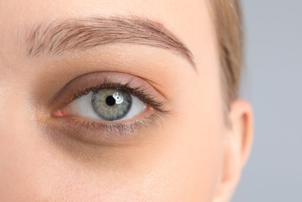 Tired young woman with dark circle under eye, closeup